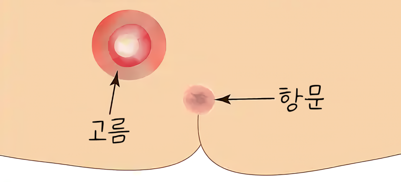 금호동 치루, 반복되는 항문 고름의 원인