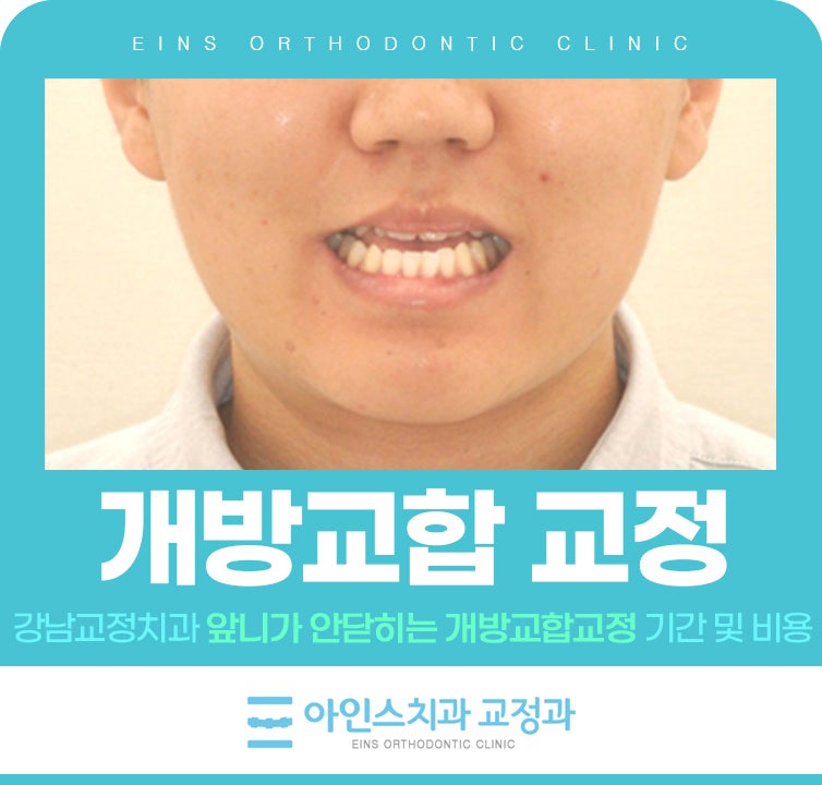 앞니가 안닫히는 개방교합교정 기간 및 비용