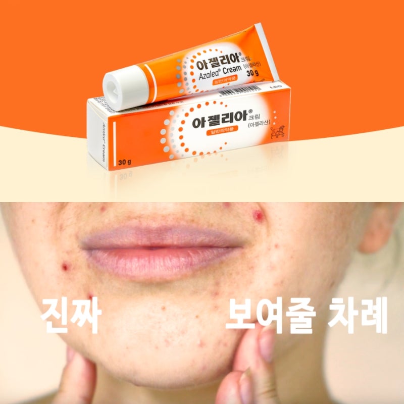 약국 여드름 연고 아젤리아크림 사용법 가격 총정리