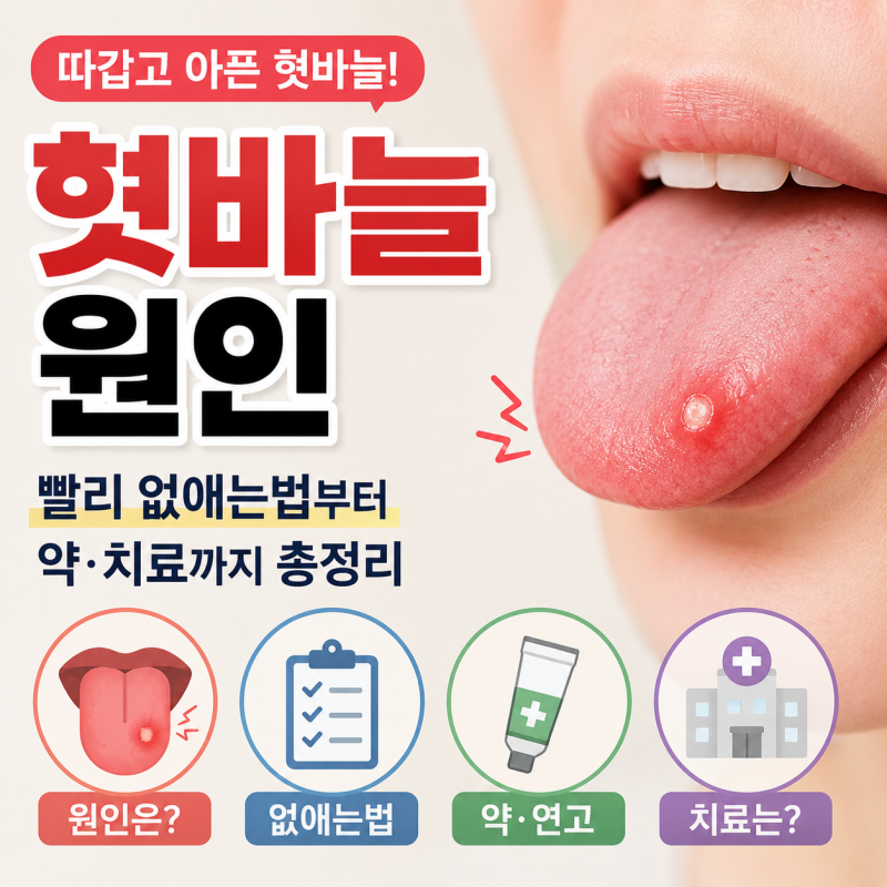 혓바늘 원인, 빨리 없애는법부터 약·치료까지 총정리