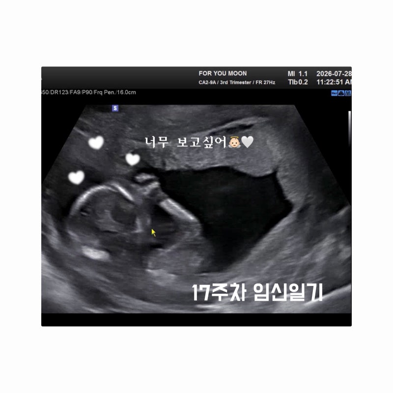 [임신일기] 17주차 임산부 감기 걸리다... (임산부 영양제 복용)