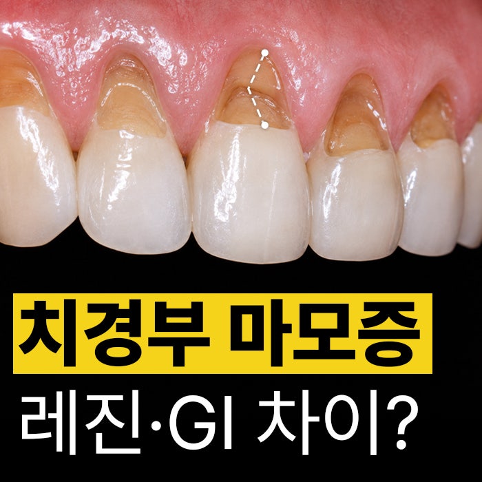 치아 패임 원인, 치경부 마모증 레진 GI 보험 차이는?