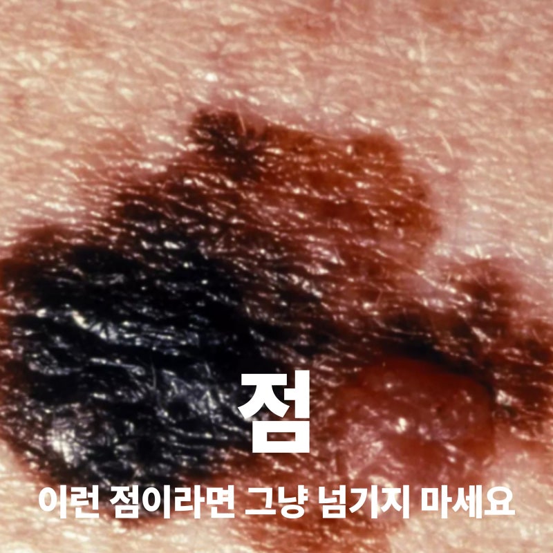 내 몸에 이런 점이 있는지 확인해 보세요