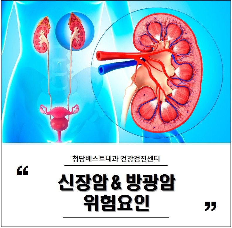 비뇨계 대표암 신장암과 방광암의 위험 요소