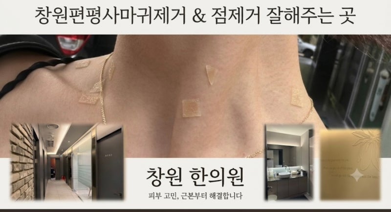 창원편평사마귀제거 잘해주는 곳 창원점제거 창원한의원 후기