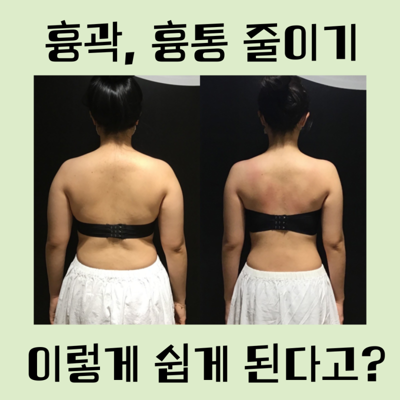 흉통 흉곽줄이기 스트레이트 체형도 슬랜더 체형으로