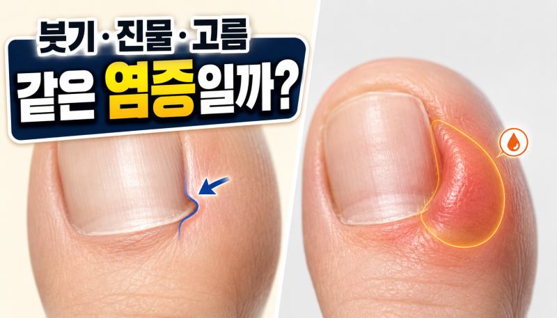 발톱 옆이 붓고 고름이 날 때, "내성발톱 염증"인지 "조갑주위염"인지 보는 법