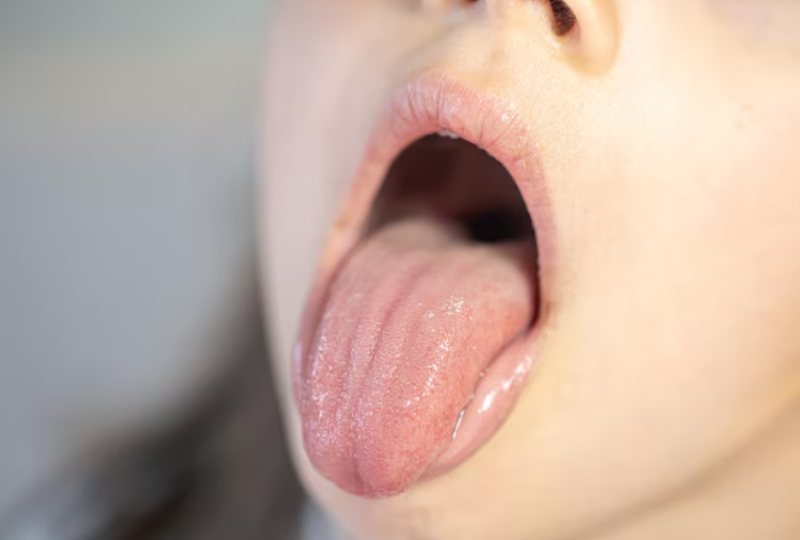 혓바닥 백태 제거법 갈라짐 1달 관리 후기