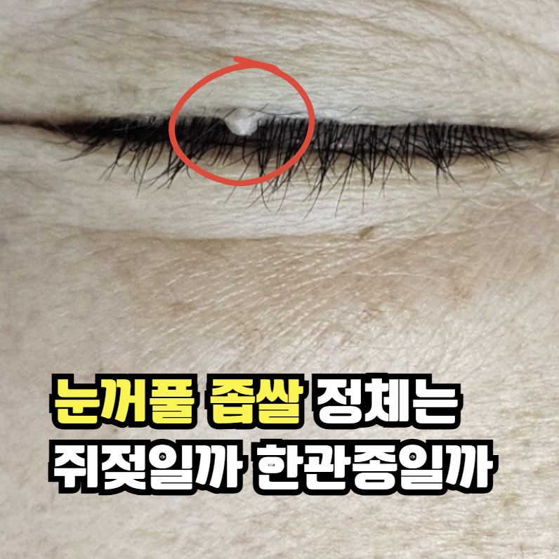 눈꺼풀 쥐젖 제거 전, 이게 정말 오돌토돌 쥐젖인지 확인하셨나요?