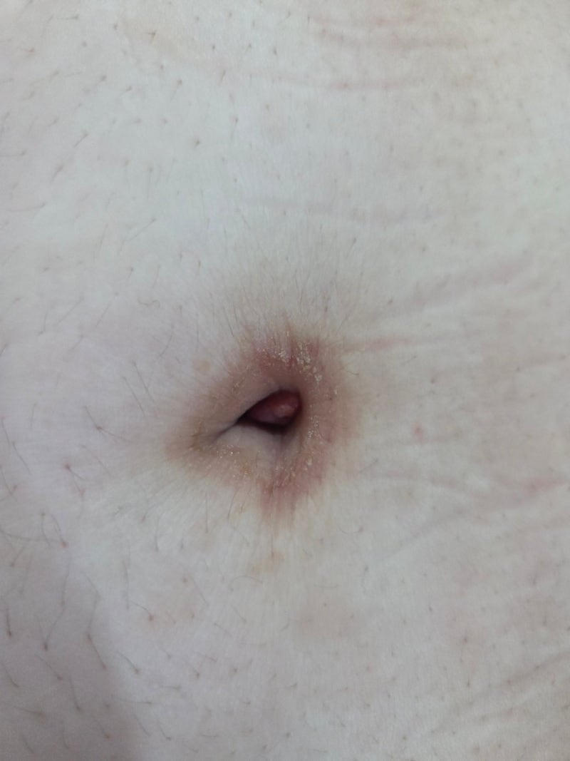 배꼽에 생긴 피지낭종