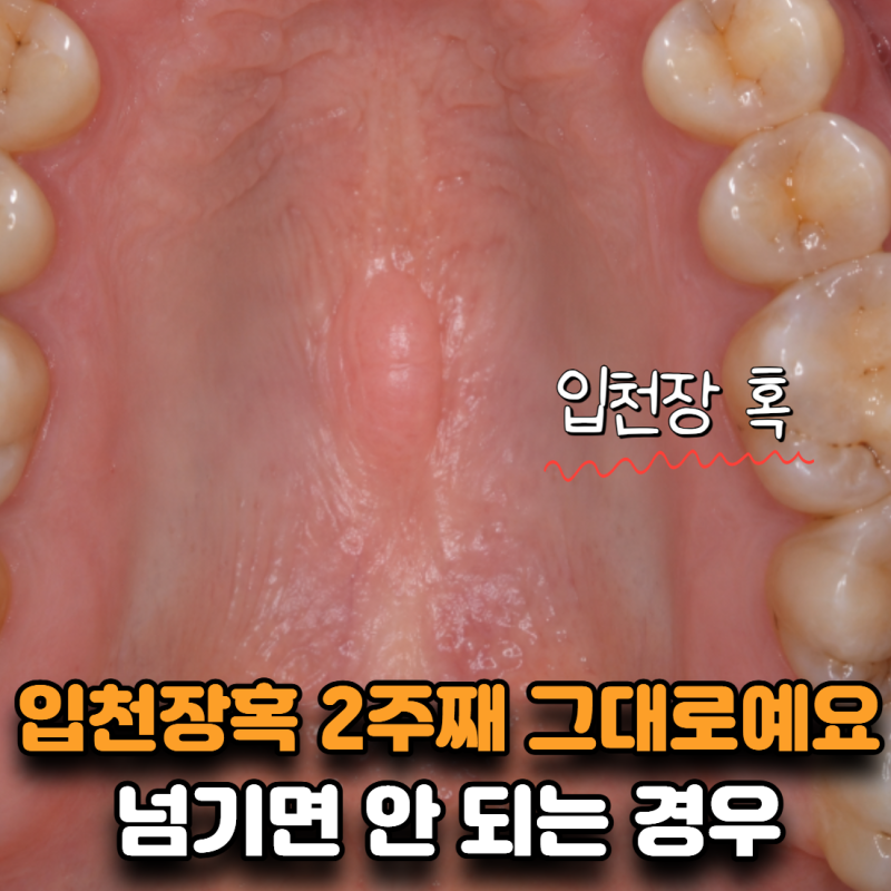 “입천장혹이 2주째 그대로예요” 그냥 염증으로 넘기면 안 되는 경우