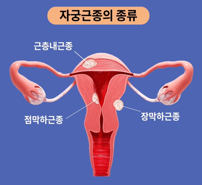자궁근종 증상 관리에 도움 되는 음식과 피해야 할 식품 3가지