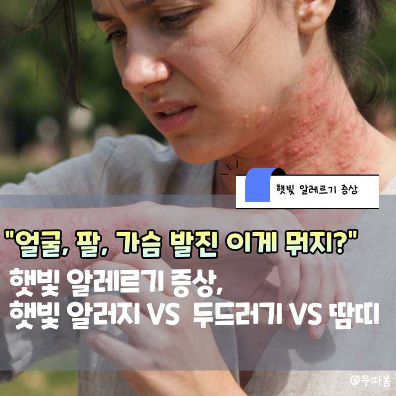 햇빛 알레르기 증상, 얼굴 발진 햇빛알러지 VS 두드러기 VS 땀띠 구분법