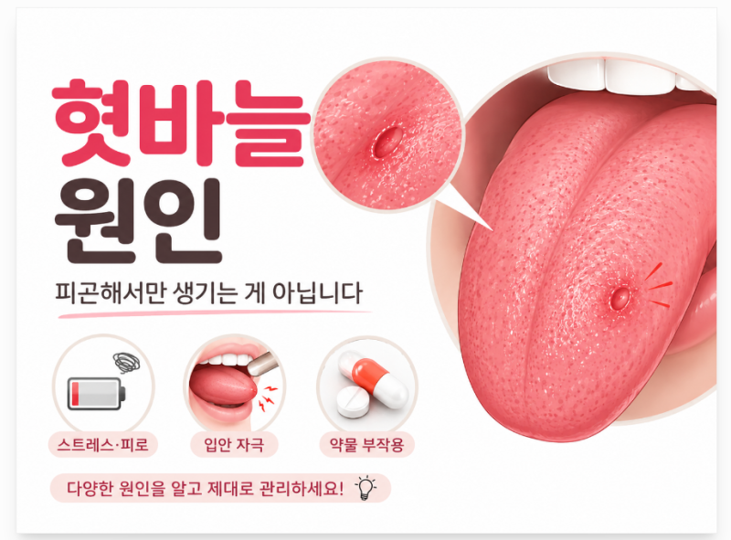 혓바늘 원인, 피곤해서만 생기는 게 아닙니다. 재발원인부터 병원에 가야 하는 경우