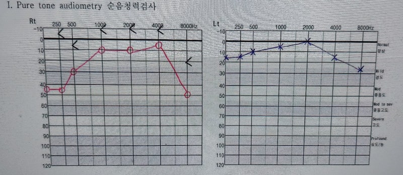 돌발성 난청 가장 궁금한 질문 10가지 ②｜청력 회복·이명·귀먹먹함·소리 왜곡·재발
