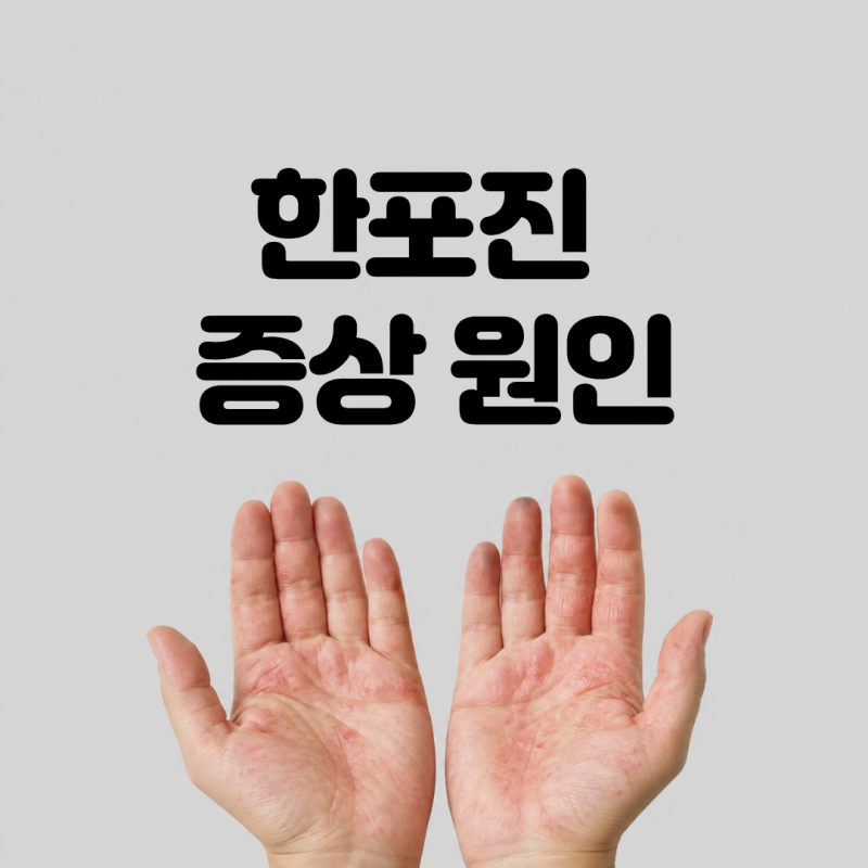 손가락 옆 자잘한 물집과 가려움, 무좀일까? 한포진 증상 원인 치료 예방법