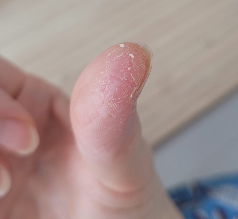 손가락 건선일까 습진일까? 헷갈리는 증상부터 피부과 진료 기준까지