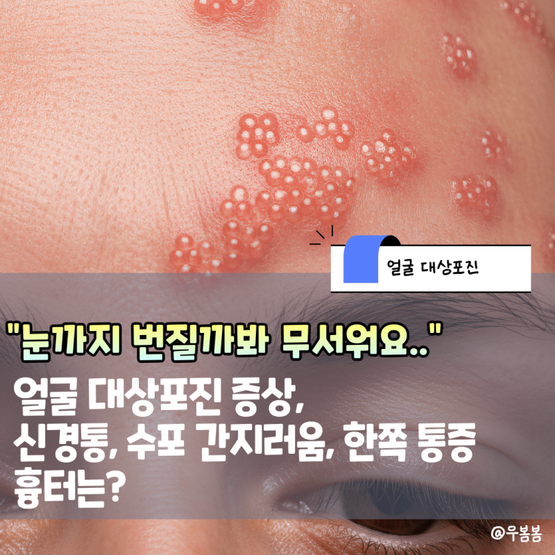 얼굴 대상포진 증상, "눈까지 번질까봐 무서워요ㅠㅠ" 신경통, 수포 간지러움 , 한쪽 통증, 흉....