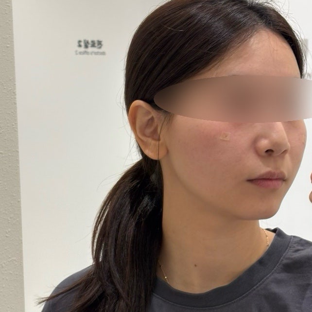 부산 연제구 피부과 고우리 스킨부스터 효과 추천 후기