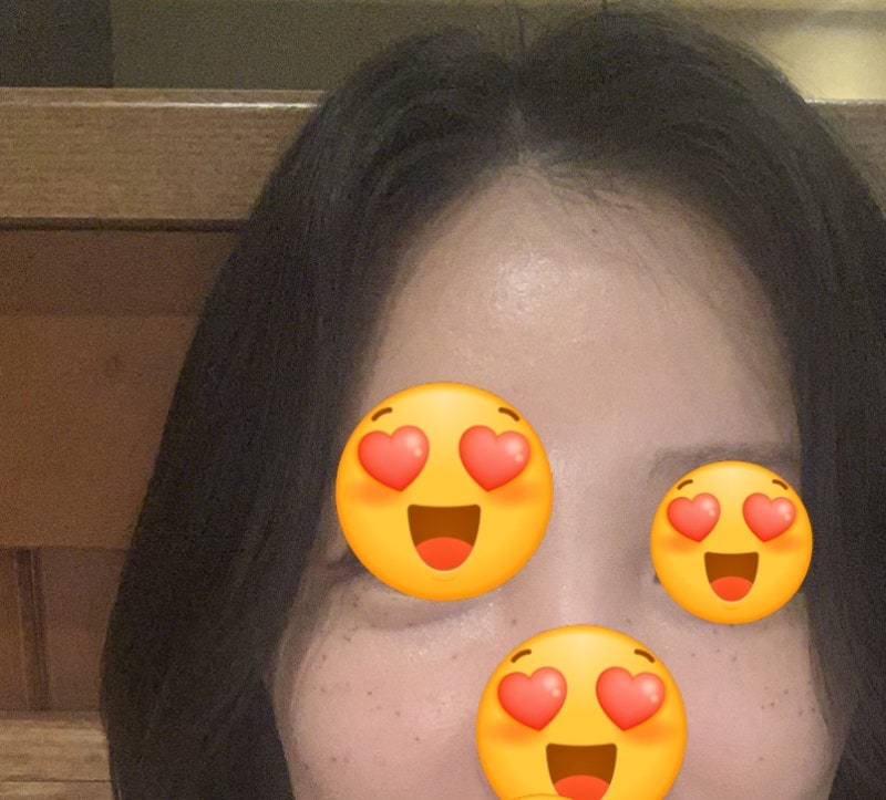 [편평사마귀 10만원대 무제한 제거 후기2편]: 흉터 안지는 관리방법, 듀오덤 사용여부, 세안법....