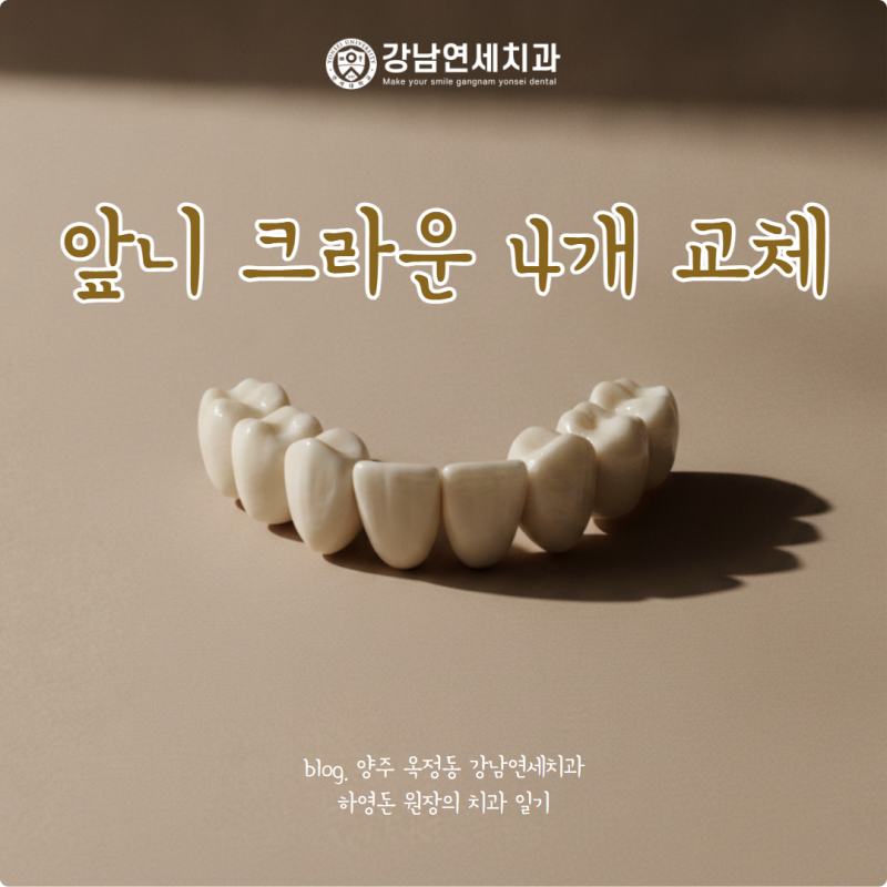 앞니 크라운 4개 교체할 때 중요시해야 할 점은? (ft. 개별 크라운)
