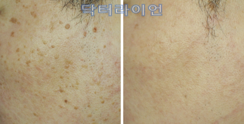 편평사마귀 제거, 깊게 할수록 좋은것이 아닌 이유_흉터·색소침착 줄이는 레이저 치료법