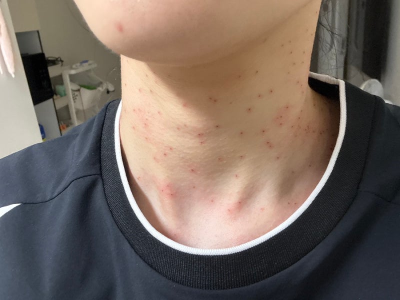 목 편평사마귀 제거 썰(목 중심) 목에 갈색 오돌토돌한 점 없애기