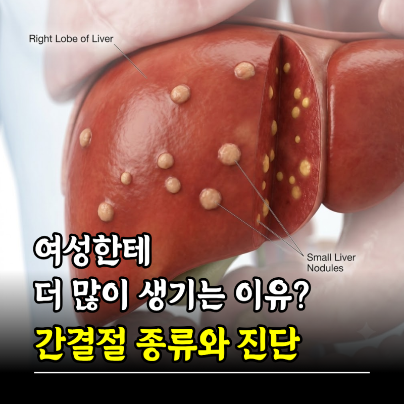 여성한테 더 많이 생기는 이유? 간결절 종류와 진단