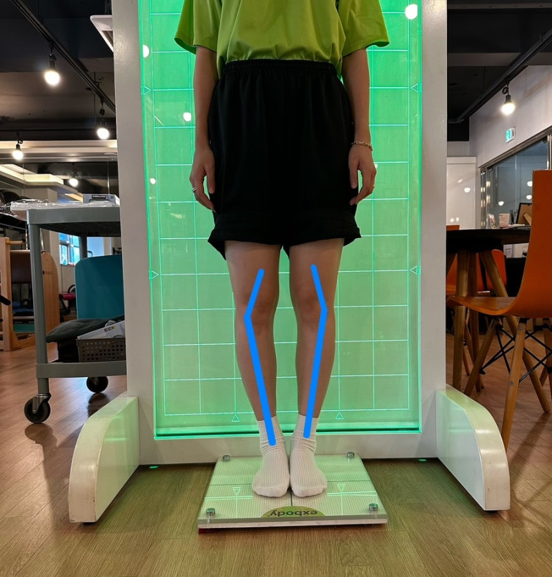 대구 오다리 교정, 무릎만 모으면 될까요? 골반부터 발목까지 봐야 하는 이유