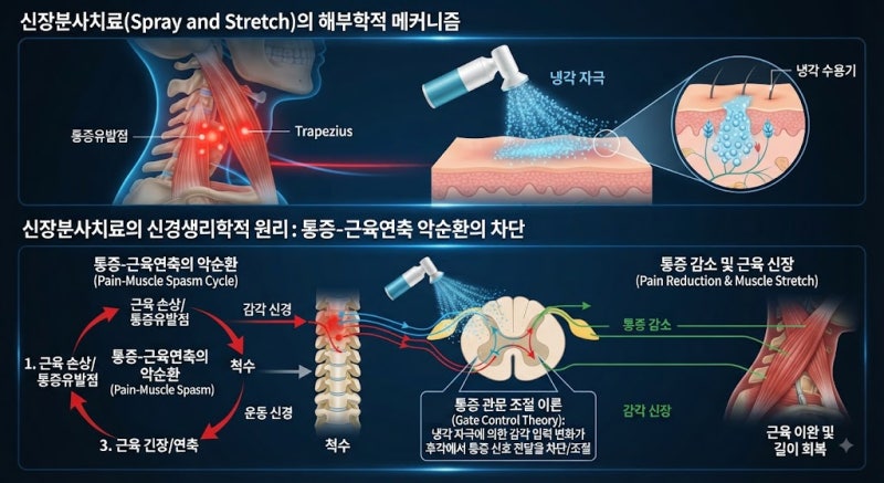 신장분사치료란? 근육 뭉침과 통증을 줄이는 Spray and Stretch 치료 원리