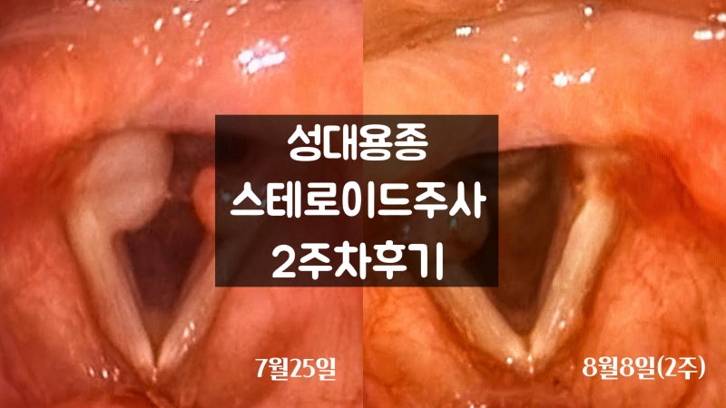 [성대용종,성대폴립] 스테로이드 주사 2주 후기