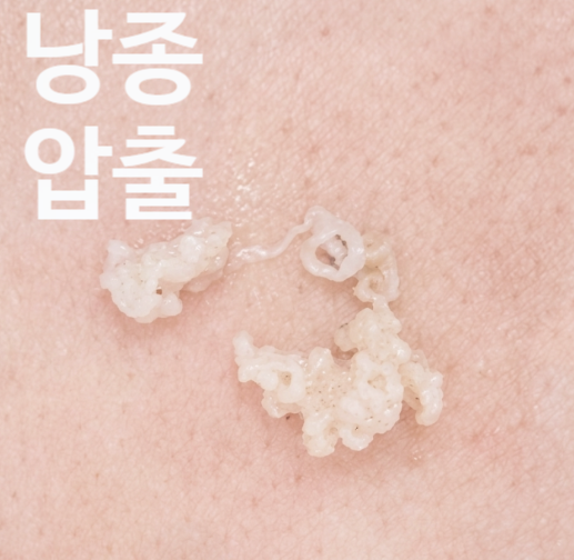사타구니 종기, 뾰루지와 달라지는 경계는 피부 아래에 있습니다