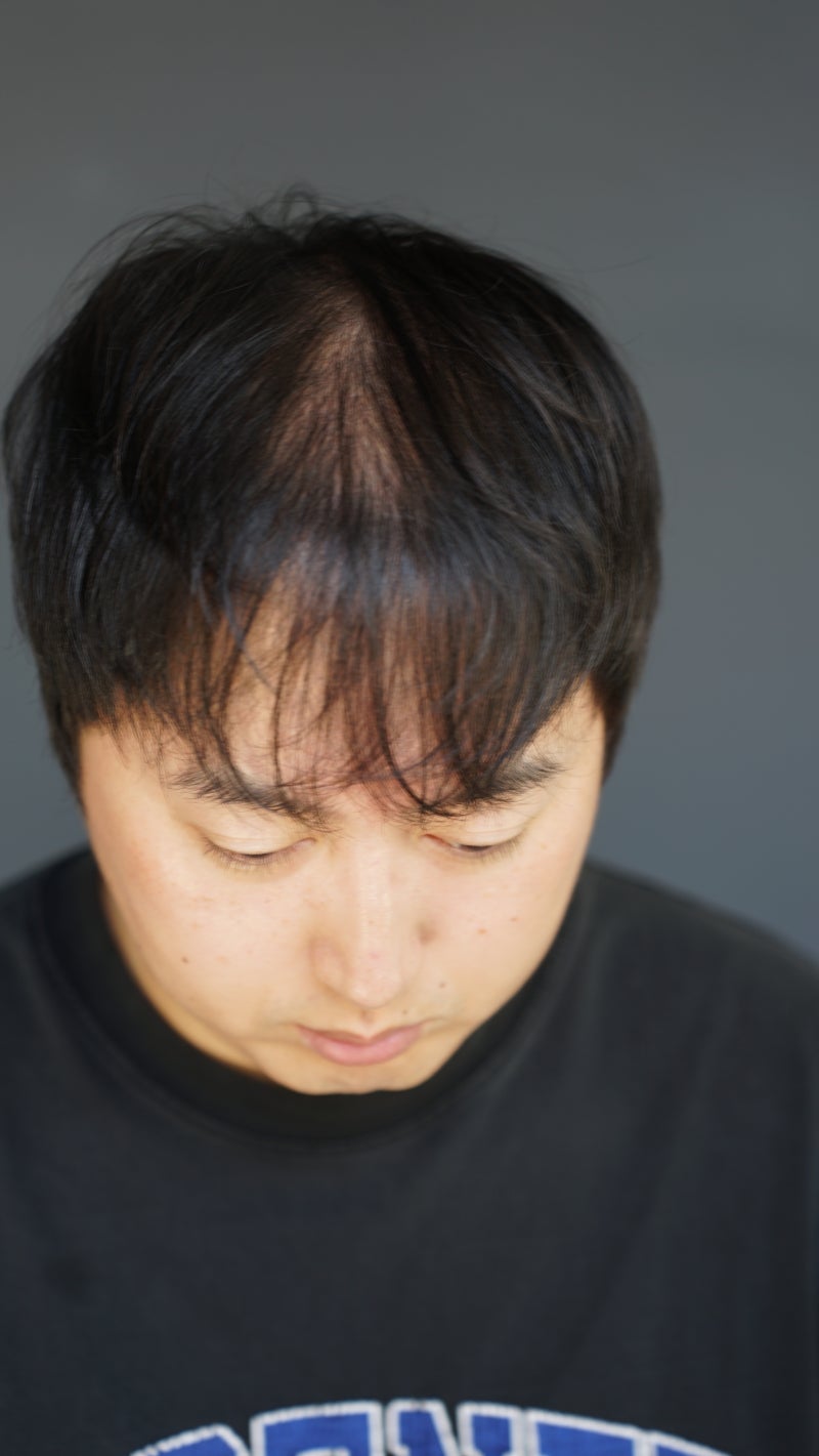 남자 앞머리 탈모는 반드시 세워야합니다