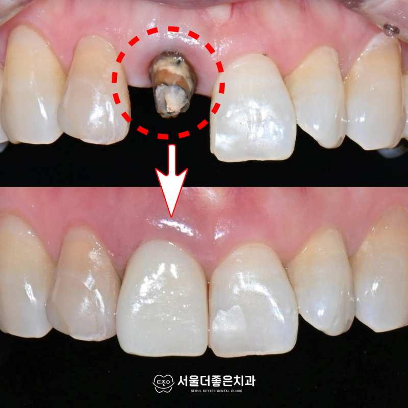 앞니 크라운 빠짐, 심한 내부 충치를 발치 대신 자연치아를 보존한 재치료 사례 (경기광주 신....