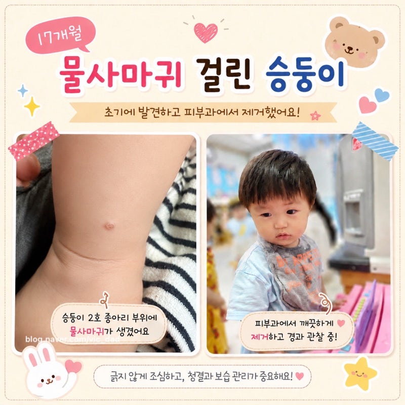 [쌍둥이 육아일기 17개월 차 - 4] 뾰루지인 줄 알았는데 알고 보니 물사마귀!? 물사마귀가 무엇....
