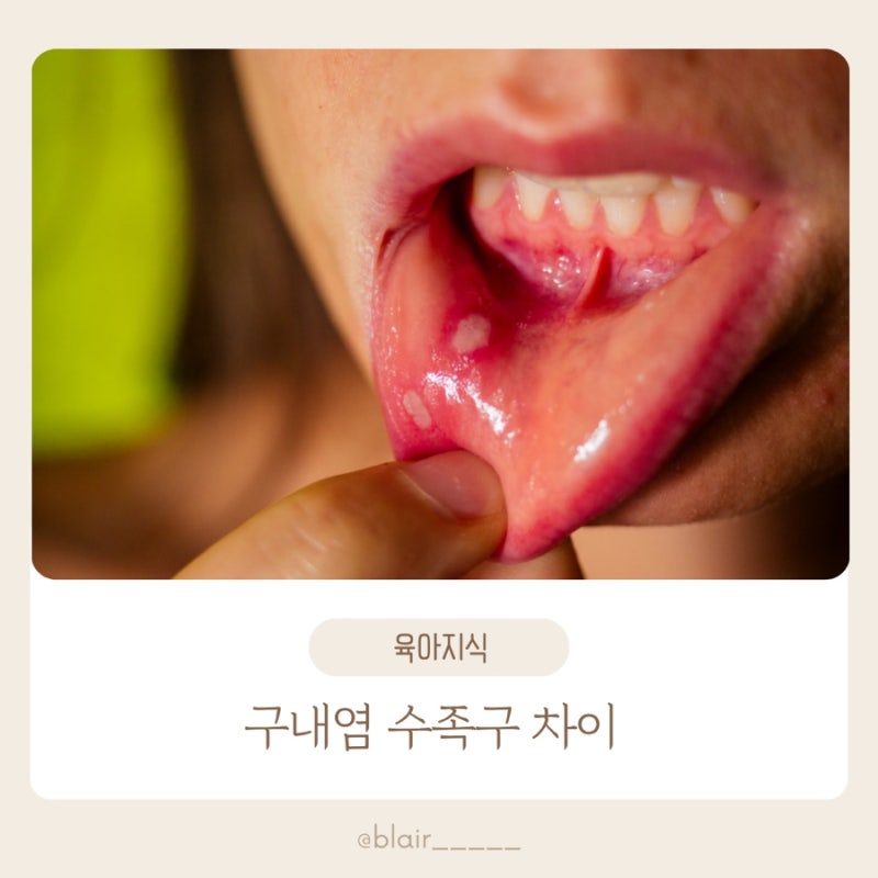 구내염과 수족구 차이점 수족구초기증상 가정보육기간 보험청구까지