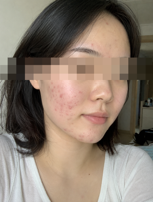 여드름 염증주사 효과와 부작용? 직접 맞아본 후기
