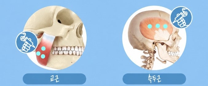 치과에서 보톡스를? 턱관절 통증,심한 이갈이, 편두통이 있다면 고려해보세요.