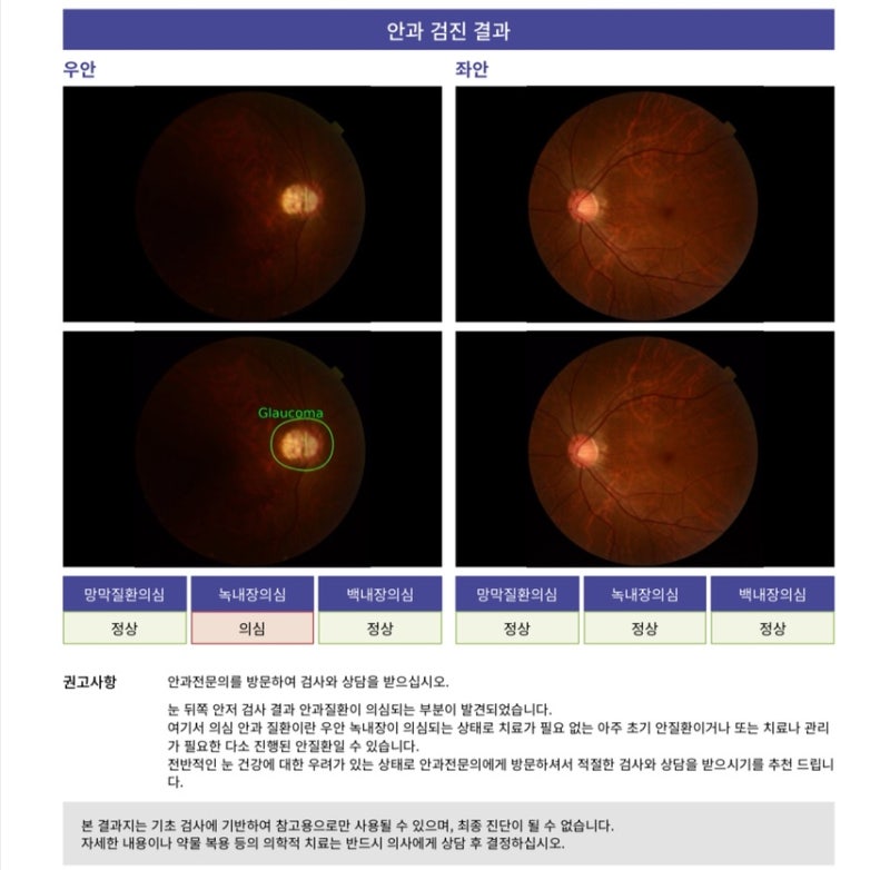 녹내장 증상, 진단방법, 치료법, 처방약