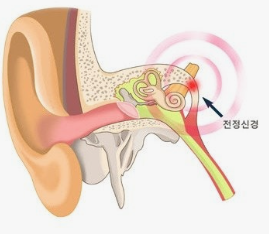 전정신경염 완치되나요? 경과 정리했어요