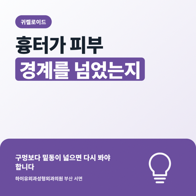 귀켈로이드 흉터가 피부 경계를 넘었는지