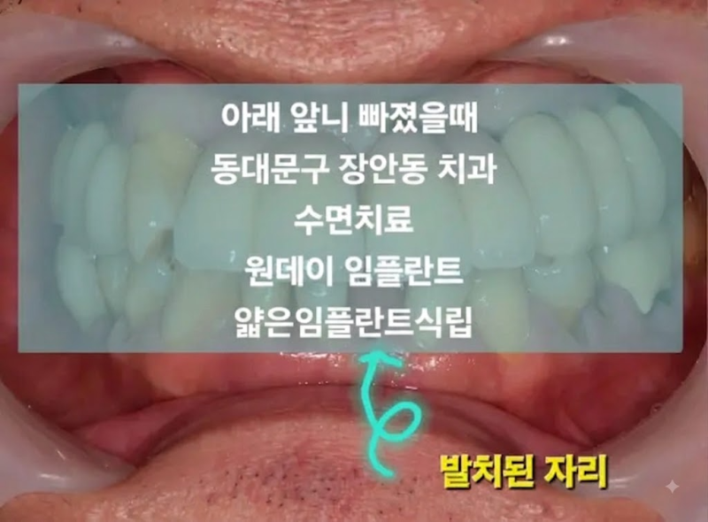 동대문구 임플란트 수면치과 | 임플란트 좁은 앞니 사이도 튼튼하게 심는 비결은?