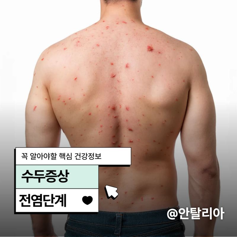 수두 증상 물집, 전염 단계와 격리기준
