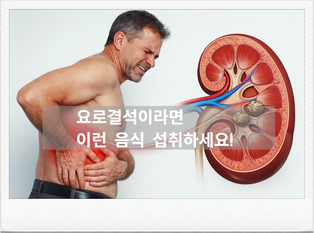 요로결석 예방에 '칼슘' 피해야 할까? 의외의 반전 음식과 영양제 주의사항 정리