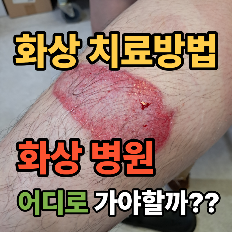 강동구 화상 치료 방법 및 화상병원은?