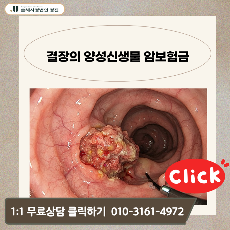 결장의 양성신생물 암보험금, D12.6 진단받고 단순 용종으로 포기하고 계신가요?