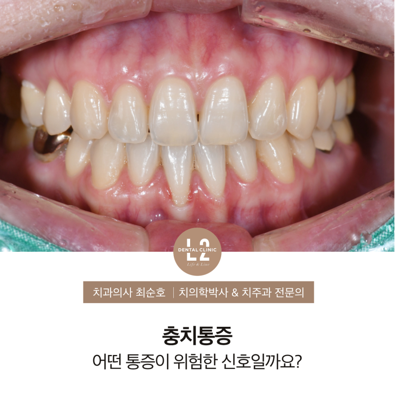 잇몸내려앉음 치료, 결합조직이식술은 언제 선택할까요?
