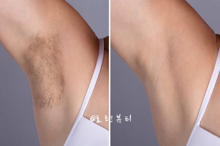 셀프 왁싱 가능해? 얼굴 다리 전신 브라질리언왁싱