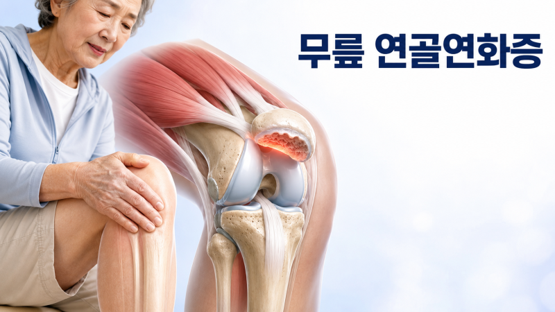 무릎 연골연화증 운동, 무릎 통증 줄이려고 시작한 허벅지 근력운동