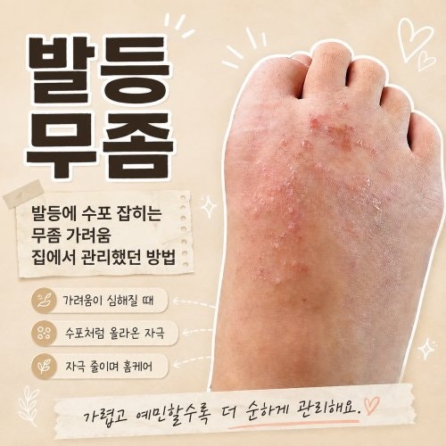 발등에 수포 잡히는 무좀 가려움 집에서 관리했던 방법